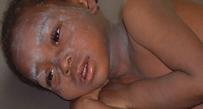 BORNO: Measles outbreak kills 13 kids, UNICEF moves in