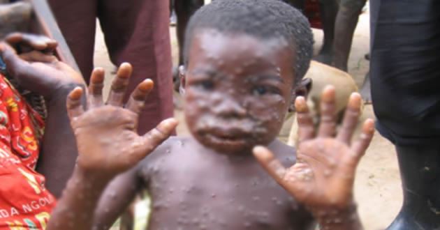 Lagos, Delta, Rivers have more cases of monkeypox in Nigeria - NCDC
