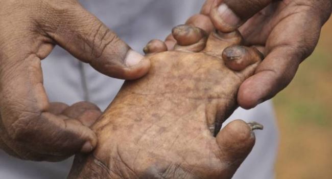 103 cases of leprosy recorded in Plateau in 2018 ---Commissioner