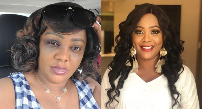 Comedienne, Helen Paul, shares photo of 'black eye' from motor accident